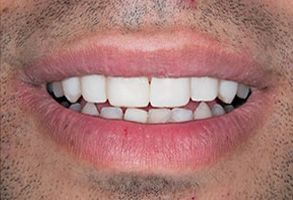 The image shows a close-up of a person s mouth with teeth, including an upper front tooth, displaying a smile.