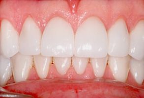 The image shows a close-up view of a person s teeth with a focus on the top row, which appears to be a dental implant or bridge, set against a contrasting background that highlights the brightness of the teeth.