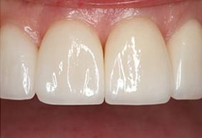 The image displays a close-up view of a person s teeth, showcasing their cleanliness and brightness after dental treatment.