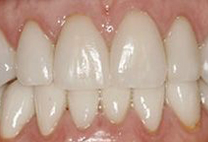 The image shows a close-up view of a person s teeth with a focus on a large gap between two front teeth, which appear to be missing or misaligned.