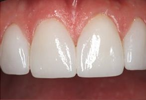 The image shows a close-up of a person s teeth with a focus on cosmetic dental work, specifically a white smile effect achieved through veneers or a similar treatment.