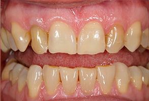 The image shows two photographs side by side of a person s teeth with yellowing and discoloration, which appears to be due to dental issues such as staining or decay.