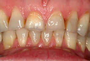 The image shows two side-by-side photographs of an individual s teeth before and after dental treatment, with a noticeable difference in color and condition between the two images.